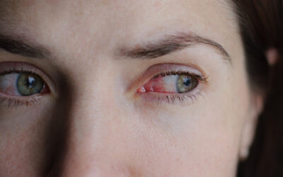 ¿Se puede trabajar con conjuntivitis en 2025?